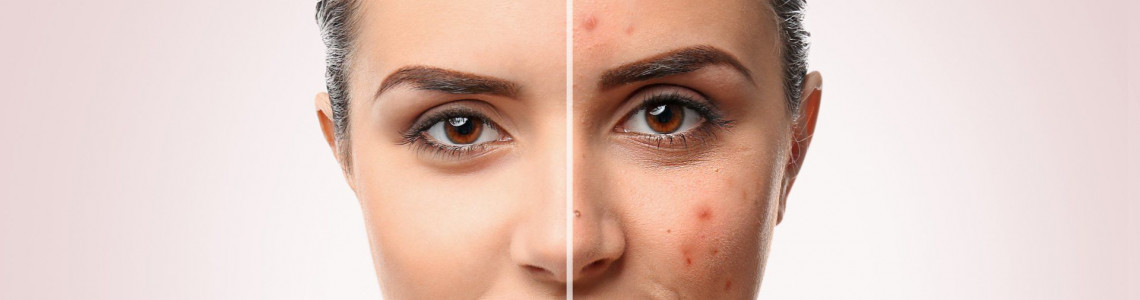 4 Common Summer Skin Problems and How to Treat Them