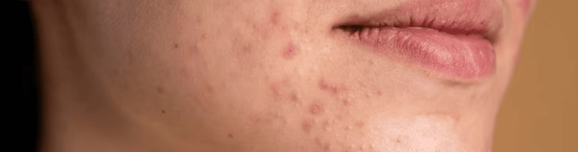 Identify Different Types of Pimples & Learn How to Treat Them