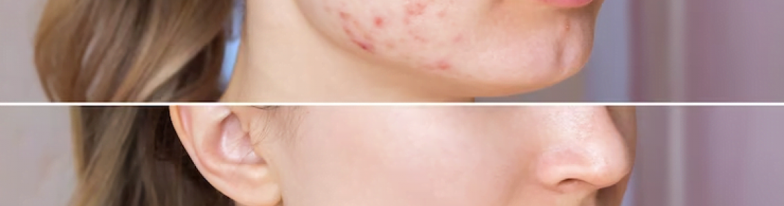 How To Get Rid Of Acne Scars: What You Need To Know